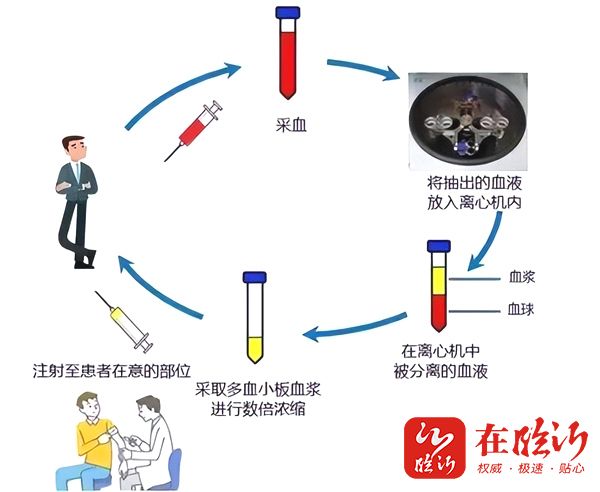 用自己的血治自己的病！临沂市人民医院富血小板血浆（PRP)疗法为患者带来康复新希望！