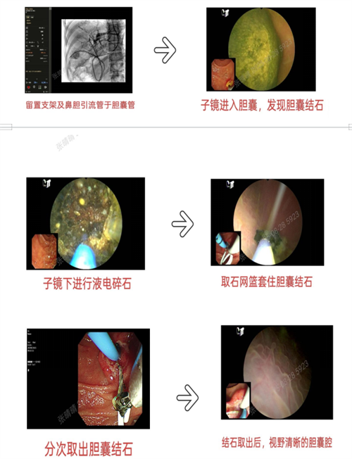 守护胆囊，微创取石 ——市人民医院内镜下保胆取石术，为患者的健康保驾护航