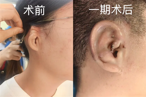 临沂市人民医院耳鼻咽喉头颈外科双突破！小耳与耳廓畸形患者在家门口重获希望