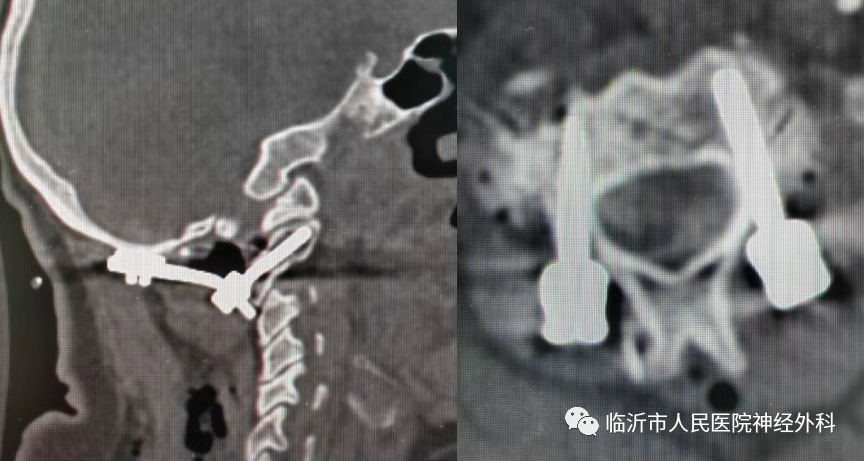 神经外科二病区（脑肿瘤与神经脊柱外科）完成复杂颅颈交界畸形手术一例